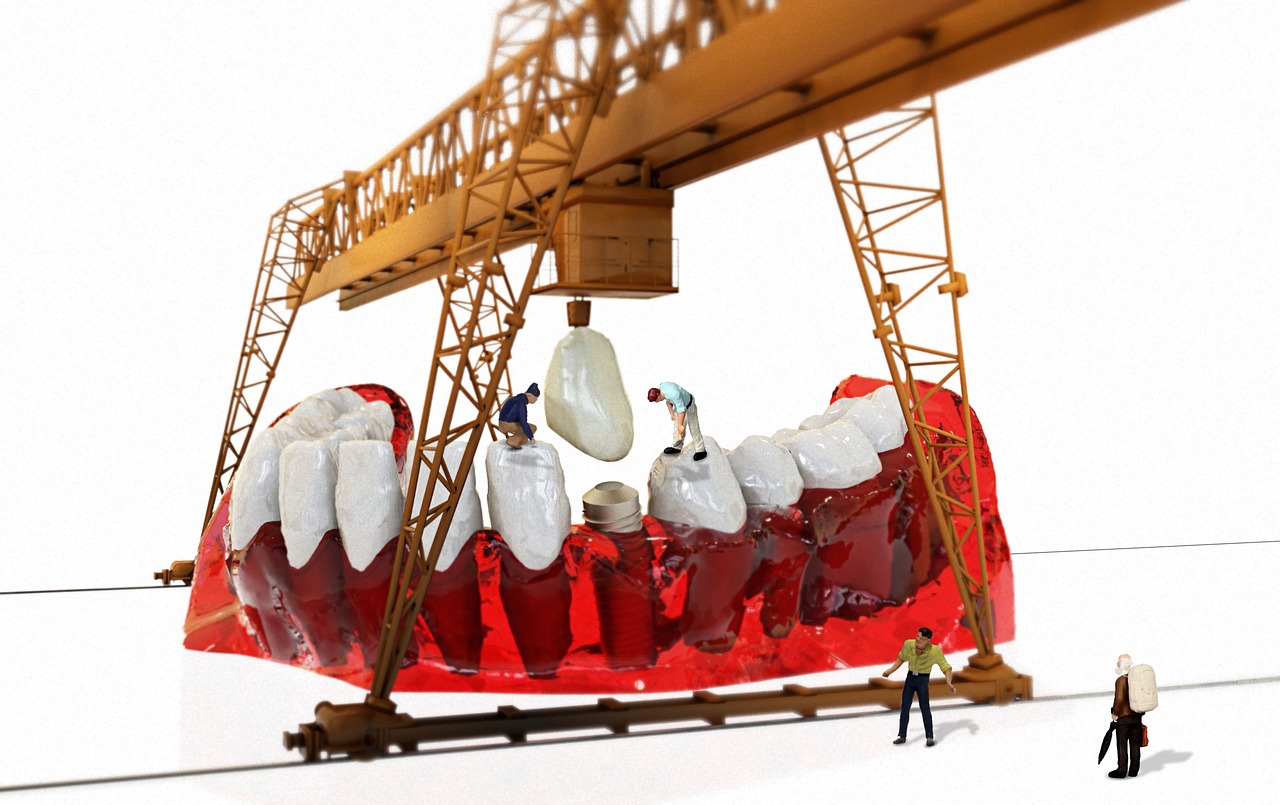 석플란트 치과 임플란트 가격